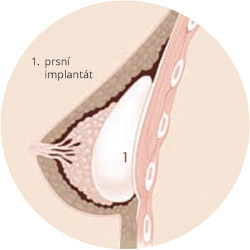 Co je prsní implantát